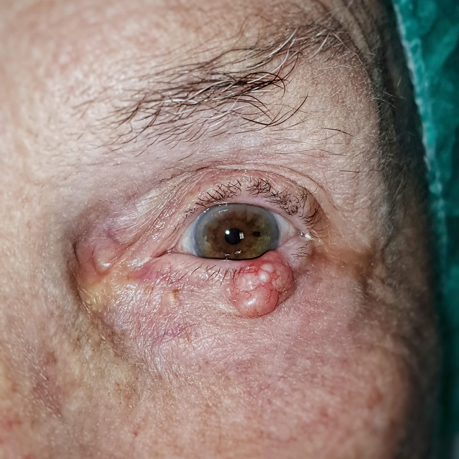 Lesione nodulare della palpebra inferiore, immagine esemplificativa