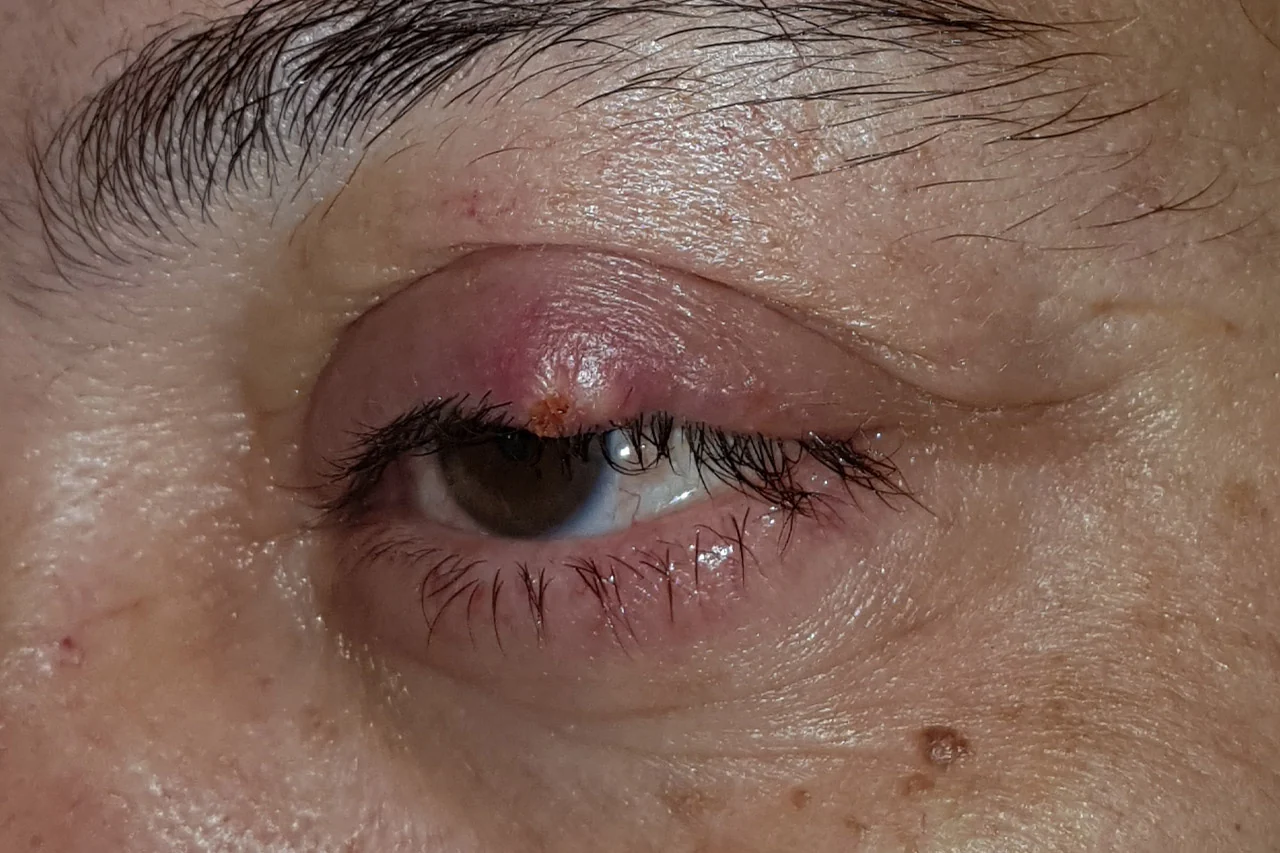 Orzaiolo con arrossamento e gonfiore della palpebra superiore