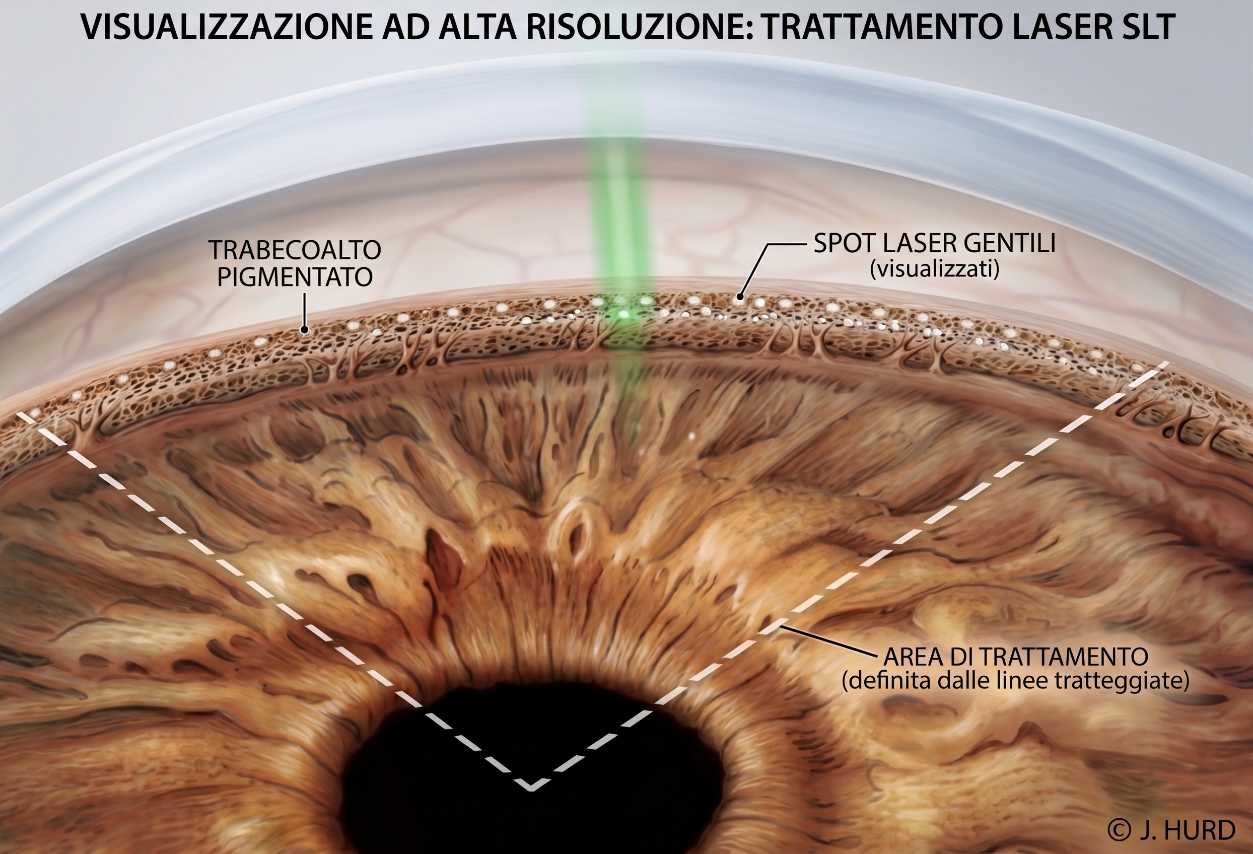 Tavola anatomica ad alta risoluzione con trabecolato pigmentato, spot laser SLT e area di trattamento