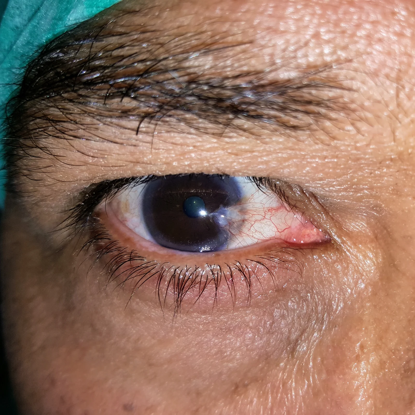 Pterigio nasale con tessuto congiuntivale esteso sulla cornea