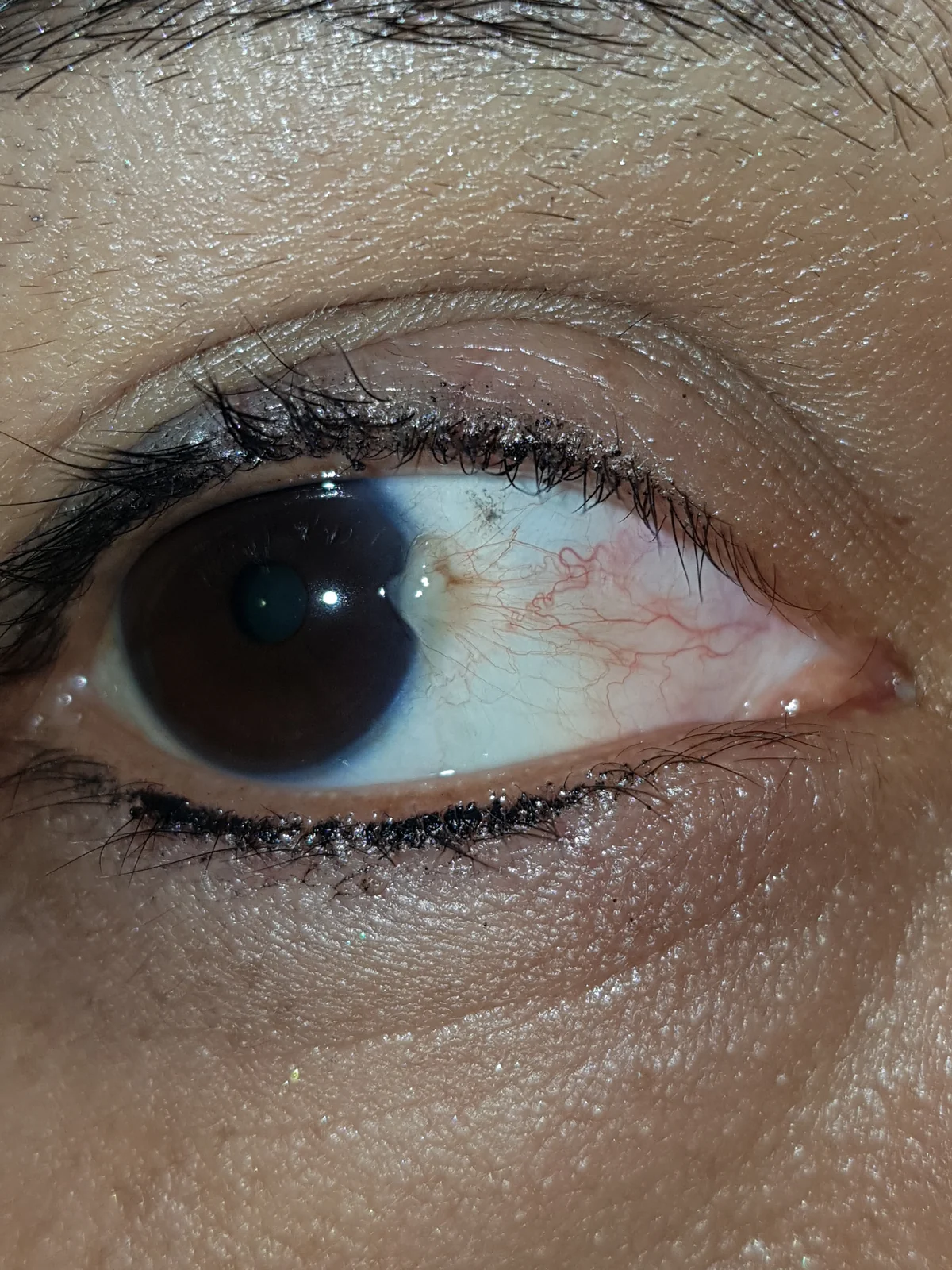 Pterigio fibrovascolare rilevato che avanza sulla cornea