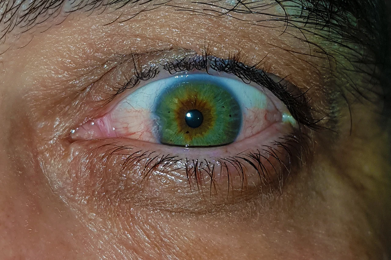 Pterigio nasale vascolarizzato che si estende dalla congiuntiva verso la cornea