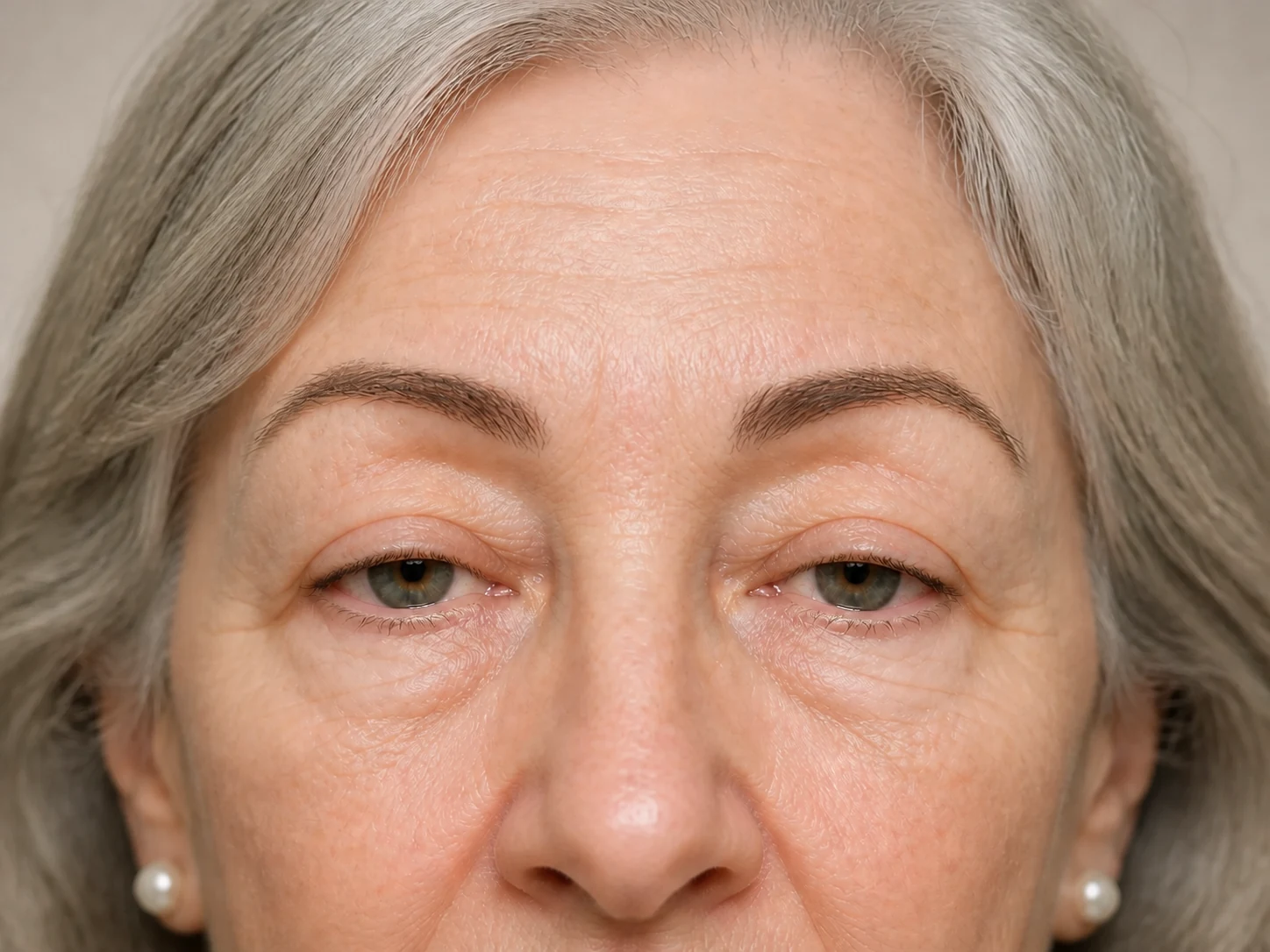 Donna adulta con abbassamento moderato e lievemente asimmetrico del margine palpebrale superiore
