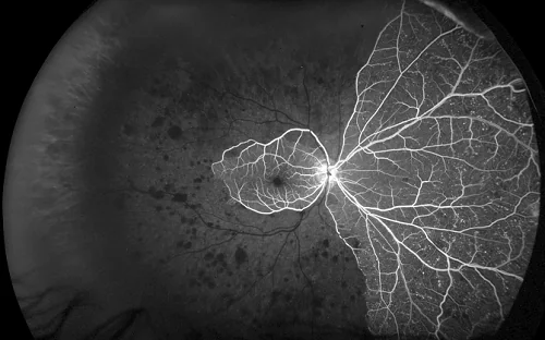 Imaging angiografico ad ampio campo in una condizione ischemica retinica