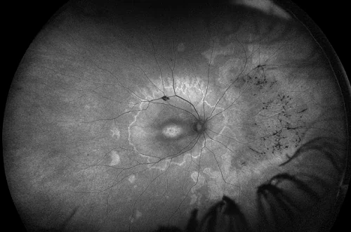 Autofluorescenza del fondo oculare in una distrofia retinica ereditaria