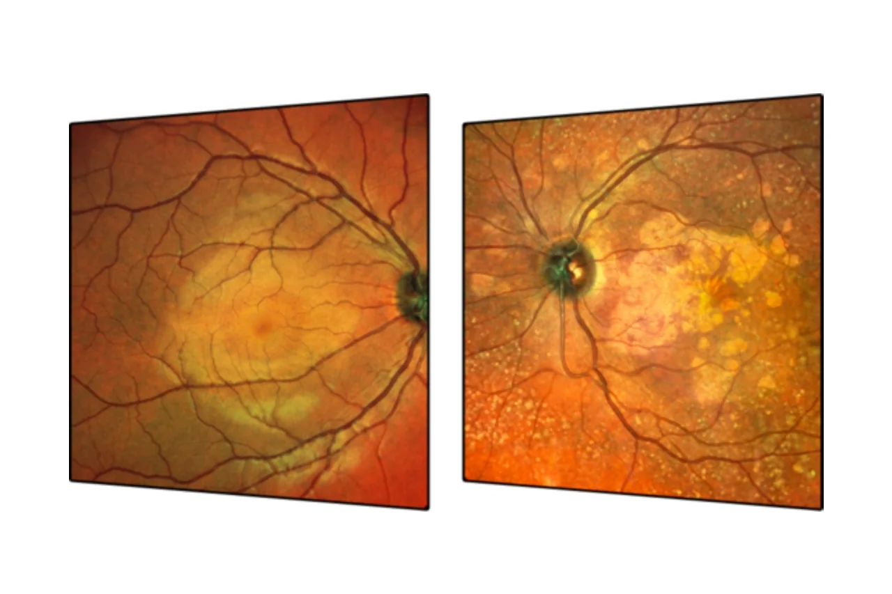 Confronto fra una macula senza evidenti alterazioni e una retina con segni di maculopatia