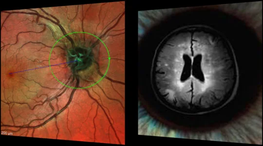 Retinografia del nervo ottico affiancata a un’immagine neurologica di riferimento