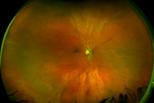 Retinografia a colori ad ampio campo di una retina sana