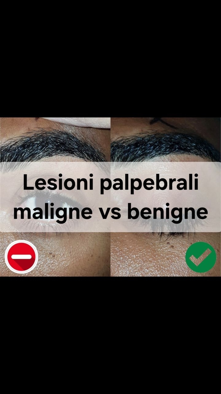 Anteprima del reel: Lesioni palpebrali: diagnosi precoce