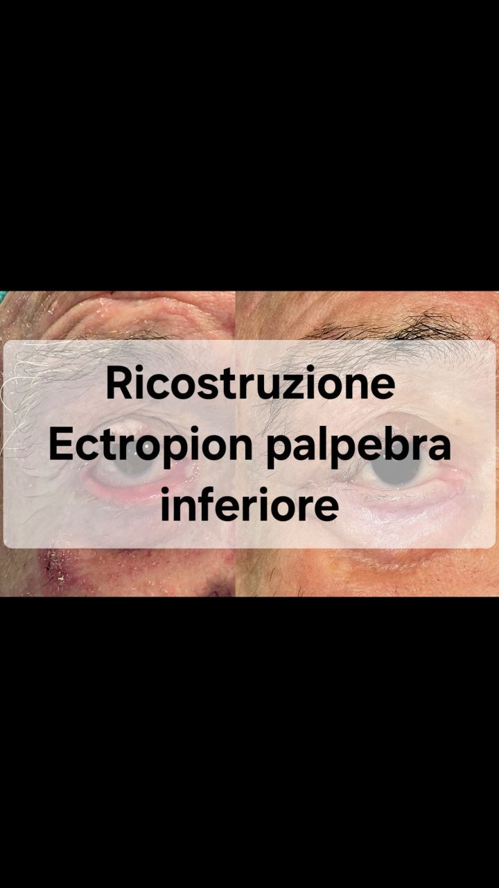 Anteprima del reel: Ricostruzione della palpebra inferiore