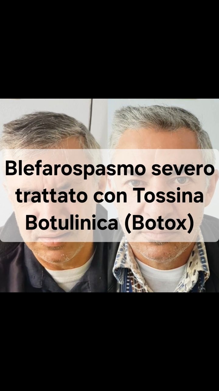Anteprima del reel: Blefarospasmo e tossina botulinica