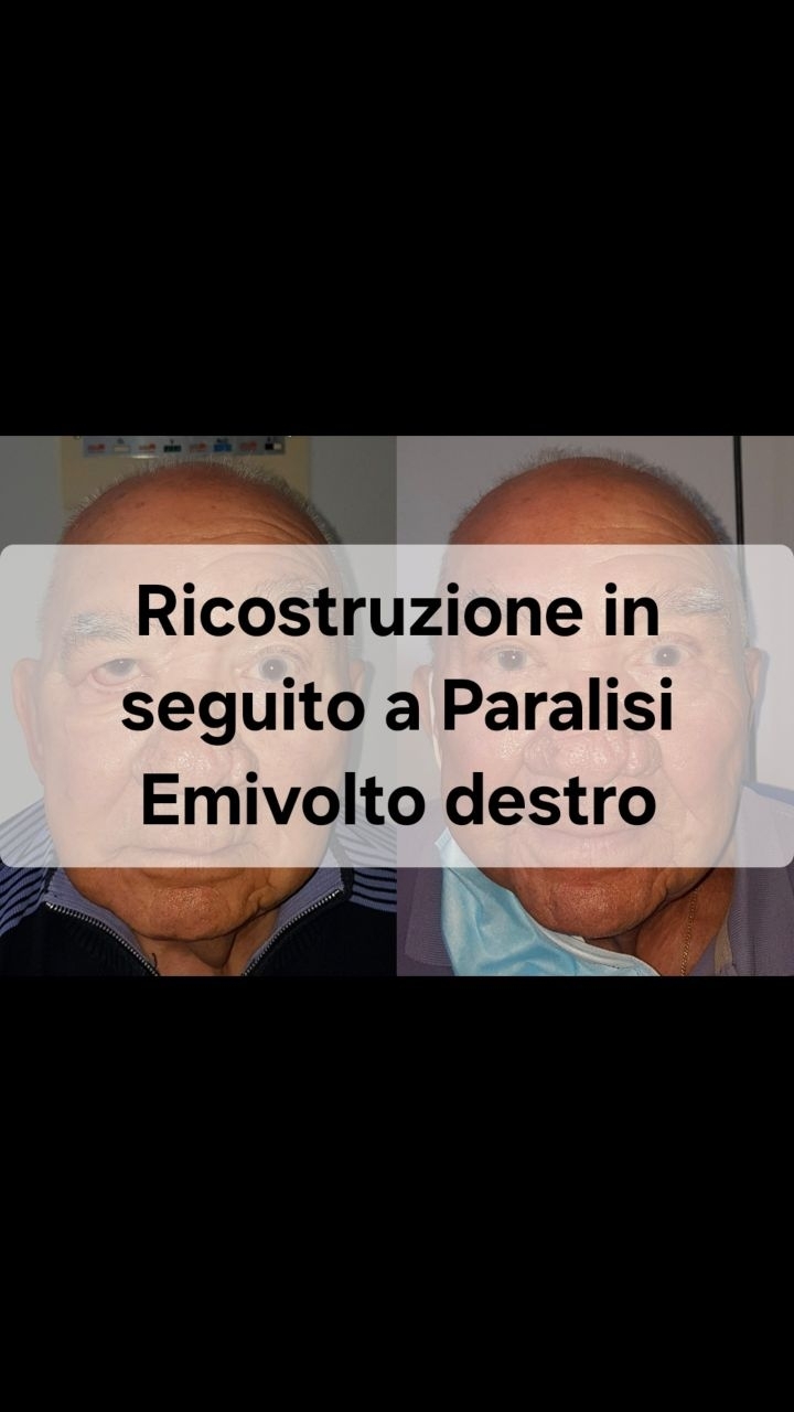 Anteprima del reel: Paralisi facciale: ricostruzione