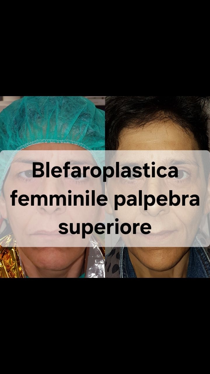 Anteprima del reel: Blefaroplastica superiore bilaterale