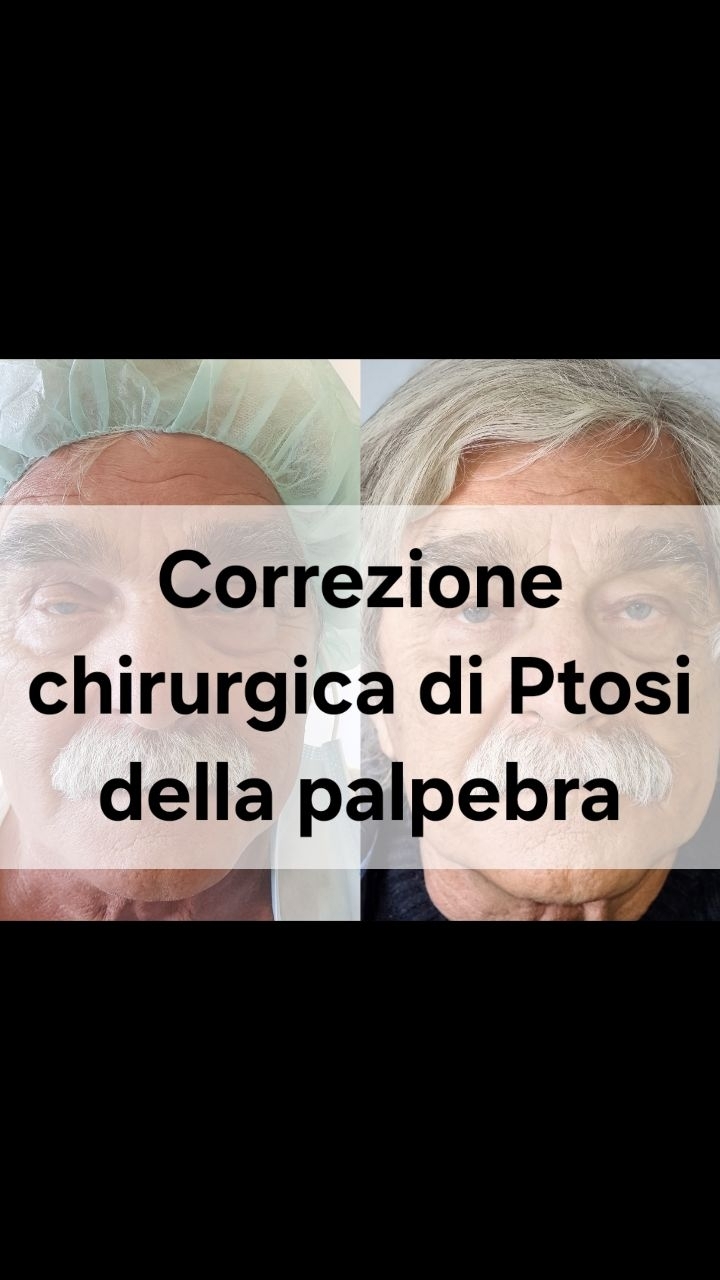 Anteprima del reel: Ptosi palpebrale bilaterale