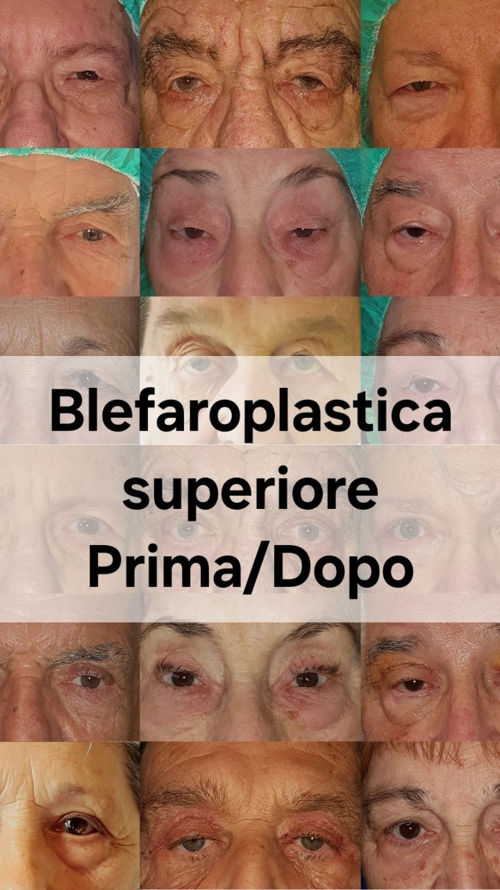 Anteprima del reel: Blefarocalasi: oltre l’estetica