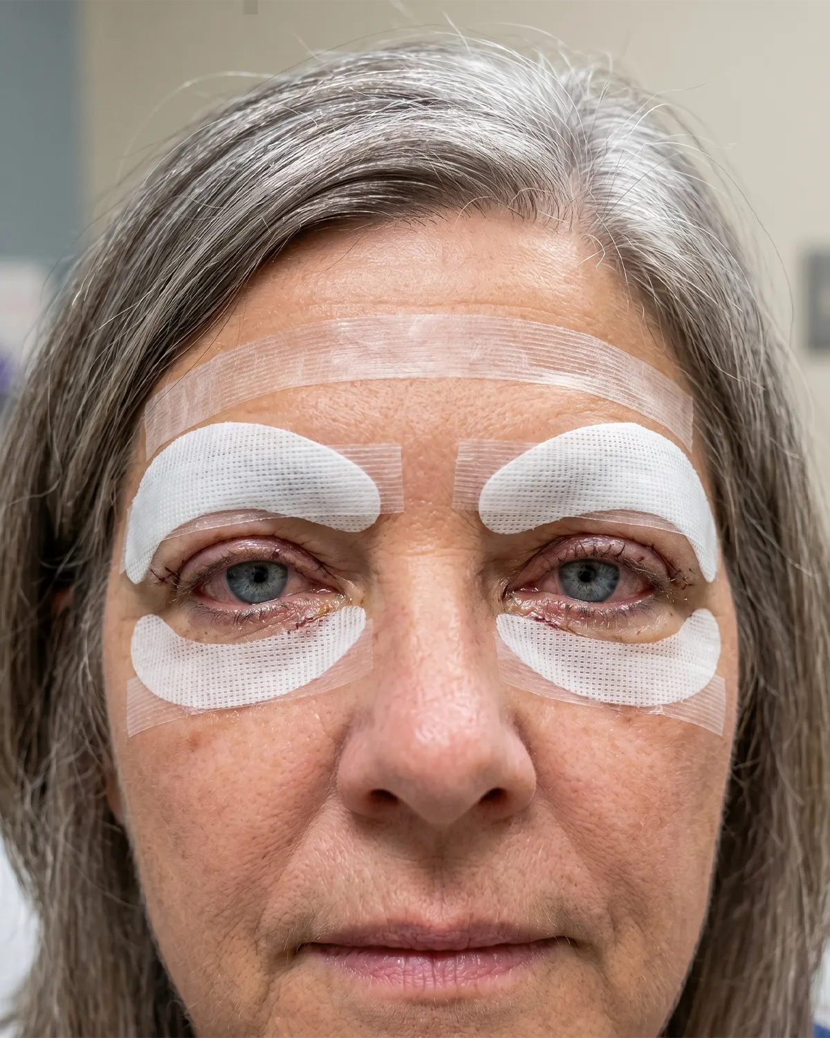 Blefaroplastica superiore: bendaggio e medicazione post-operatoria — Dott. Silvestro Caputo