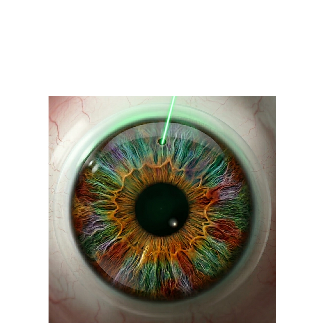Iridotomia YAG laser — glaucoma acuto, profilassi attacco
