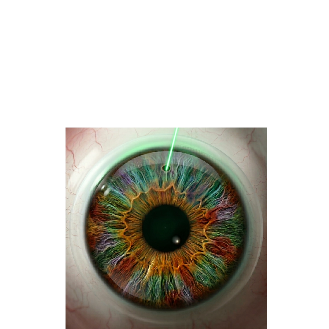 Iridotomia YAG laser — glaucoma acuto, profilassi attacco