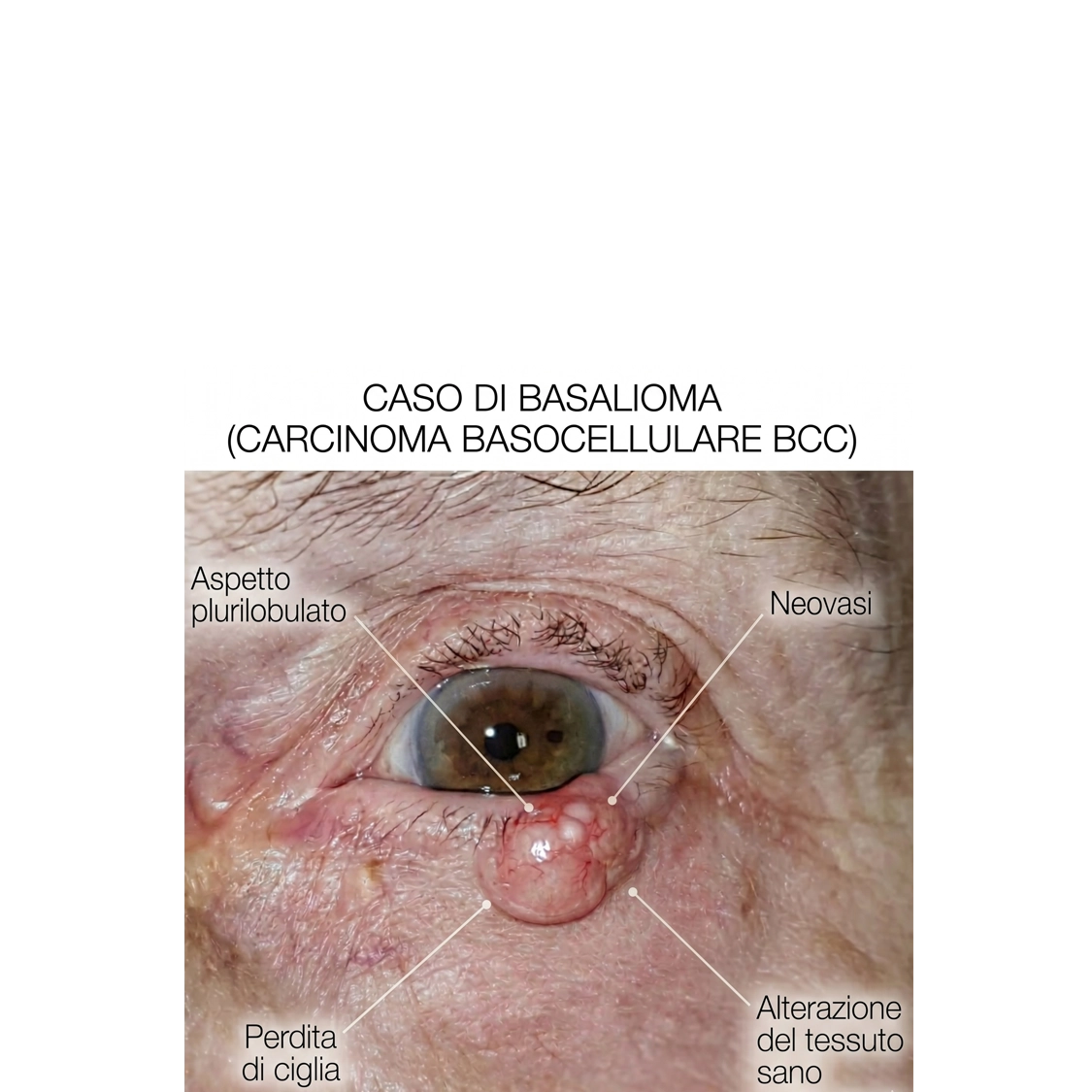 Nodulo palpebrale — basalioma BCC, asportazione chirurgica