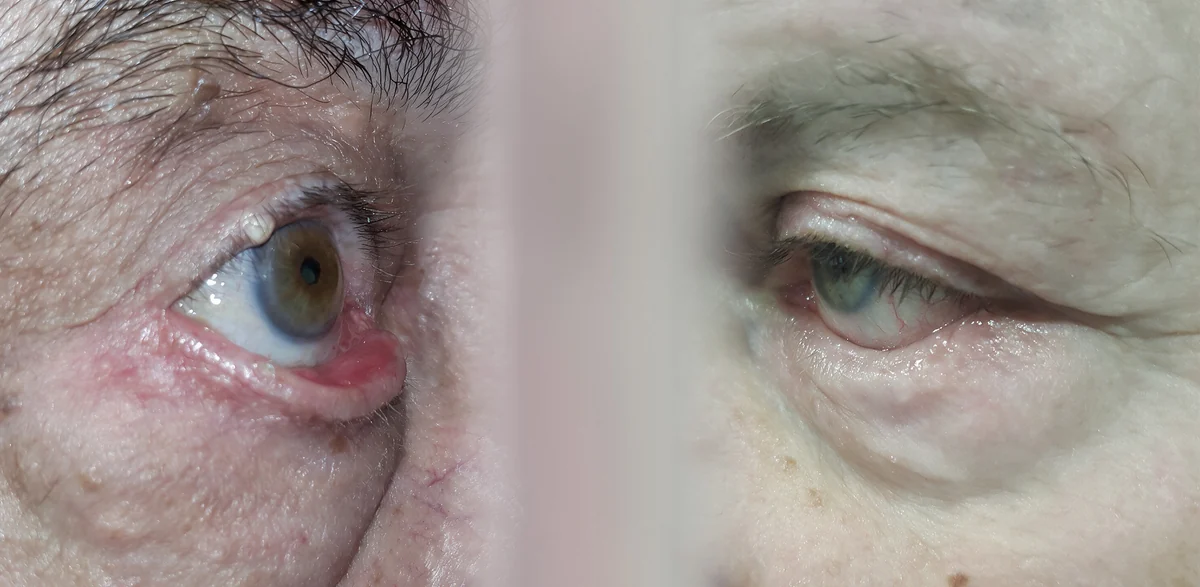 Confronto clinico tra ectropion ed entropion della palpebra inferiore
