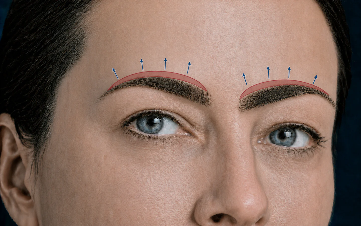 Illustrazione anatomica del sopracciglio e della direzione di riposizionamento