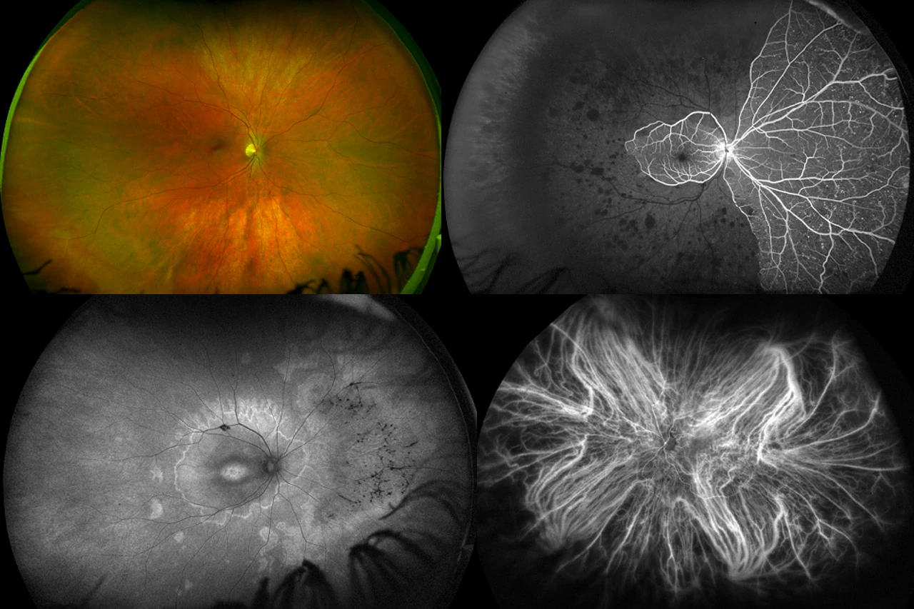 Immagini della retina ottenute con differenti tecniche diagnostiche